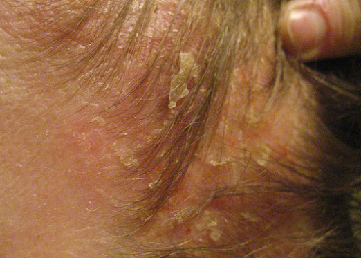 Kako liječiti seborrheični dermatitis?